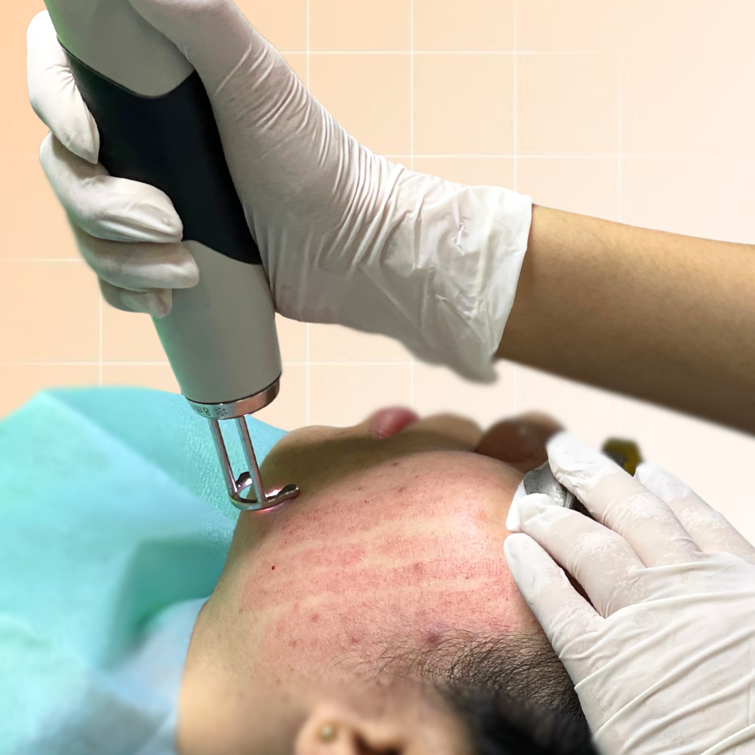 Da yếu nhạy cảm sau xâm lấn