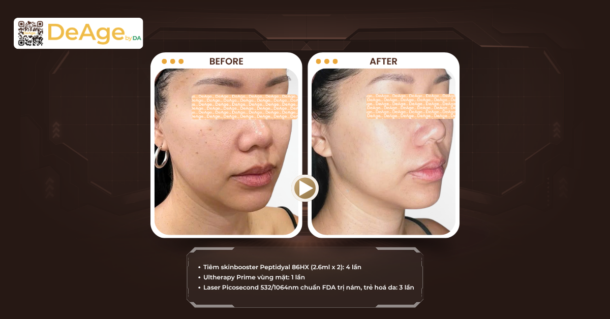 So sánh HIFU và Ultherapy: nên lựa chọn phương pháp nào để nâng cơ, trẻ hóa? 5 Điểm giống nhau giữa HIFU và Ultherapy