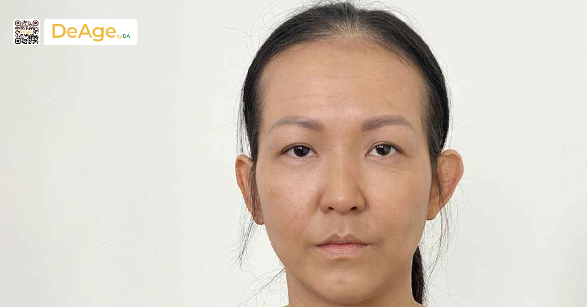 Cấy mỡ thái dương: bí quyết cải thiện gương mặt hóp và thiếu cân đối 7 Người có vùng thái dương hõm