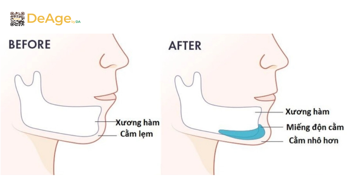 Tạo hình cằm V-line nam bằng phương pháp nào và hiệu quả duy trì bao lâu? 8 Độn cằm