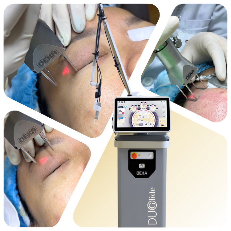 Laser Deka Duoglide - Trẻ hóa vùng mắt