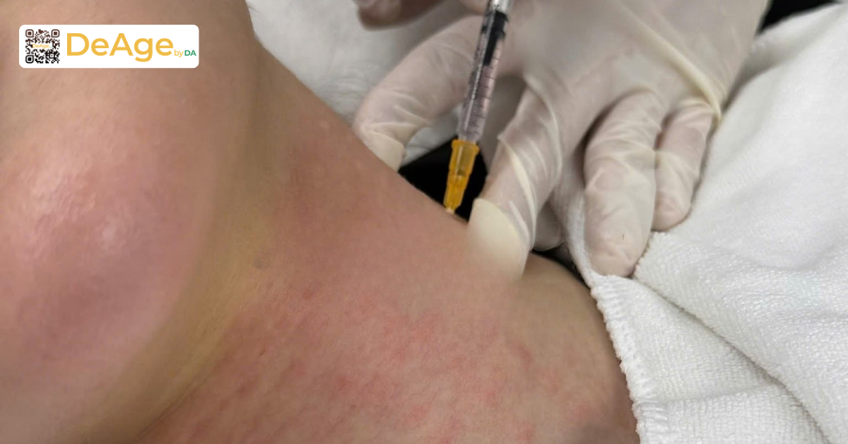 Da cổ sần sùi do đâu và cách giúp da cổ mịn màng hơn 7 Mesotherapy cổ