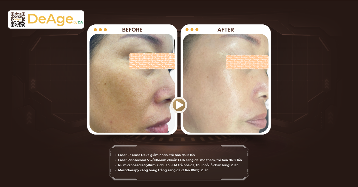 Cấy căng bóng da mang lại lợi ích gì và hiệu quả duy trì bao lâu? 9 Nên tiêm căng bóng da ở đâu uy tín và chất lượng