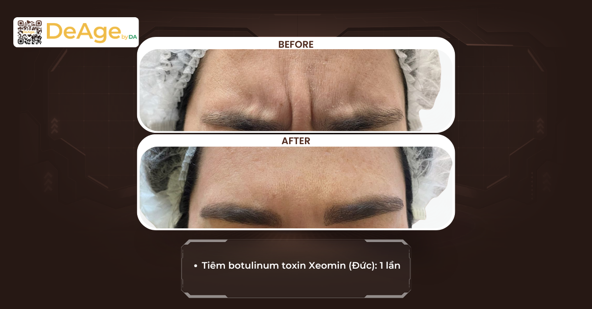 Những yếu tố ảnh hưởng đến chi phí tiêm botox