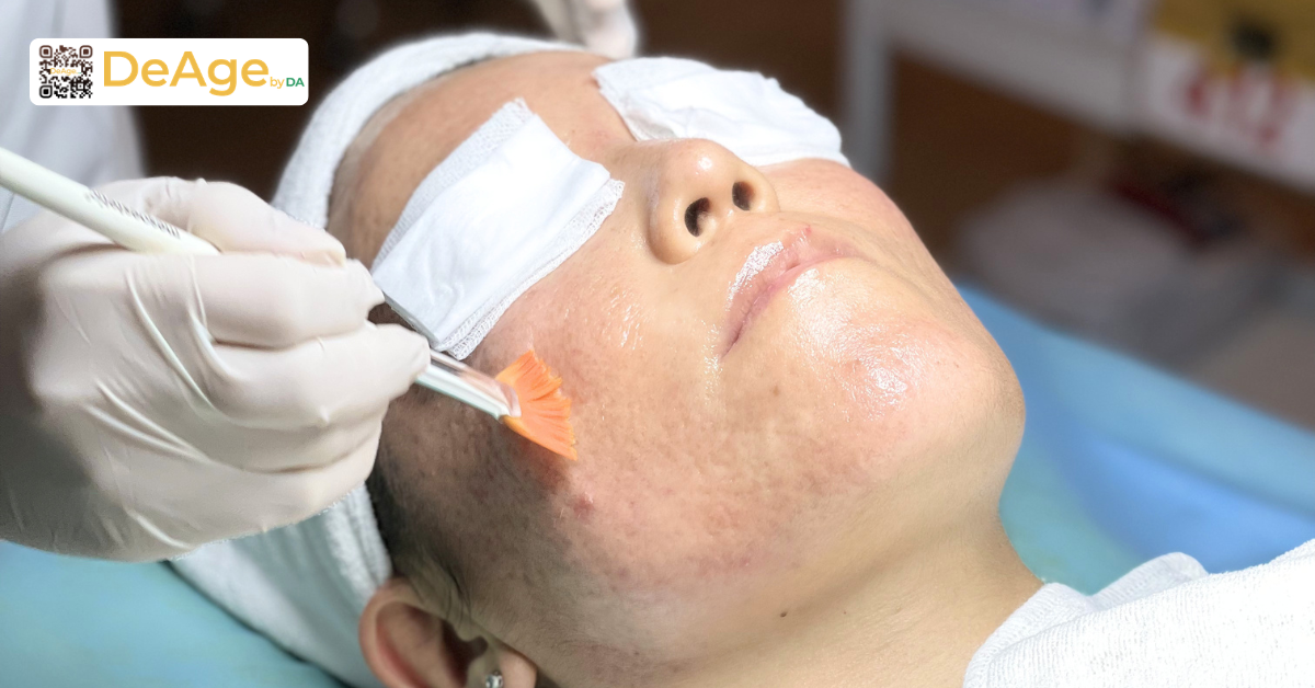 Da căng mọng: xu hướng làn da khỏe đẹp được nhiều người theo đuổi 9 Peel da hóa học