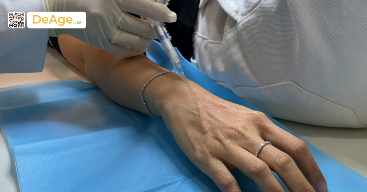 Cấy mỡ bàn tay: giải pháp cải thiện bàn tay gầy guộc và lão hóa 10 Tiêm biostimulator tay
