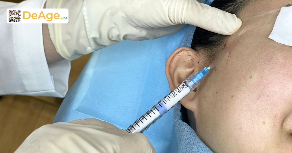 Da căng mọng: xu hướng làn da khỏe đẹp được nhiều người theo đuổi 8 Tiêm biostimulator radiesse