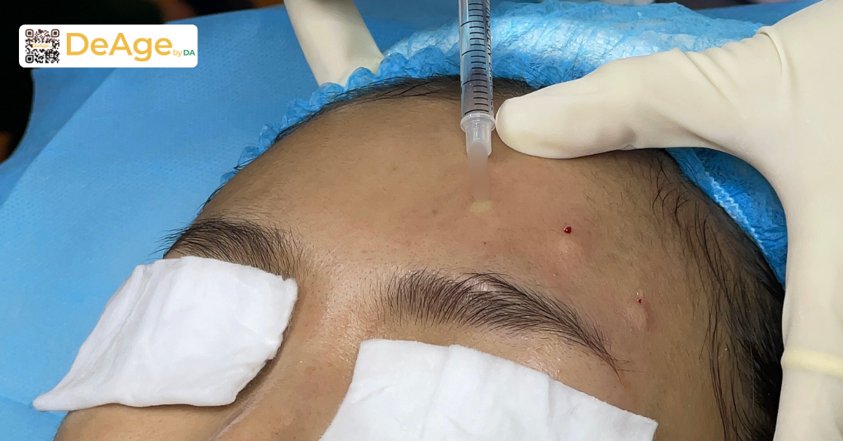 Bí quyết nâng cơ xóa nhăn không phẫu thuật giúp gương mặt trẻ trung hơn 7 Tiêm botox giá bao nhiêu