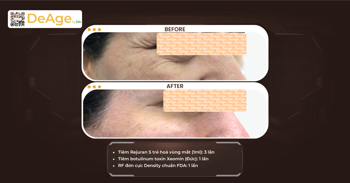 7 phương pháp xóa vết chân chim hiệu quả nhất: cách nào phù hợp với bạn? 7 CLS Tiêm skinbooster và biostimulator