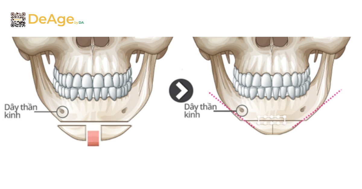 Tạo hình cằm V-line nam bằng phương pháp nào và hiệu quả duy trì bao lâu? 7 Trượt cằm