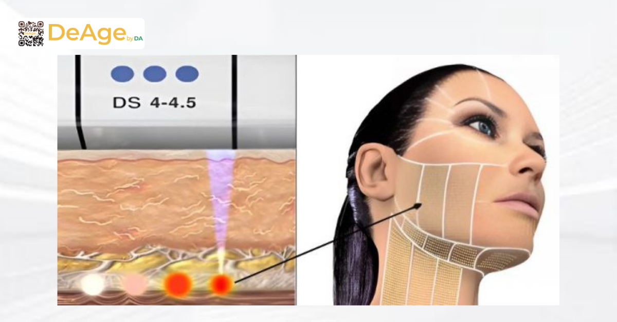 So sánh HIFU và Ultherapy: nên lựa chọn phương pháp nào để nâng cơ, trẻ hóa? 3 Ultherapy là gì