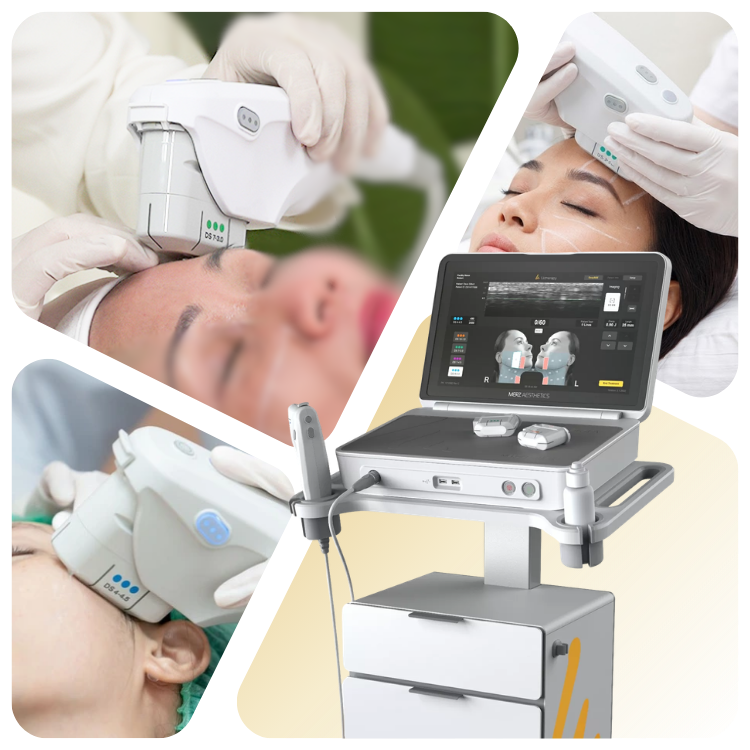 Ultherapy prime - Trẻ hóa vùng mắt