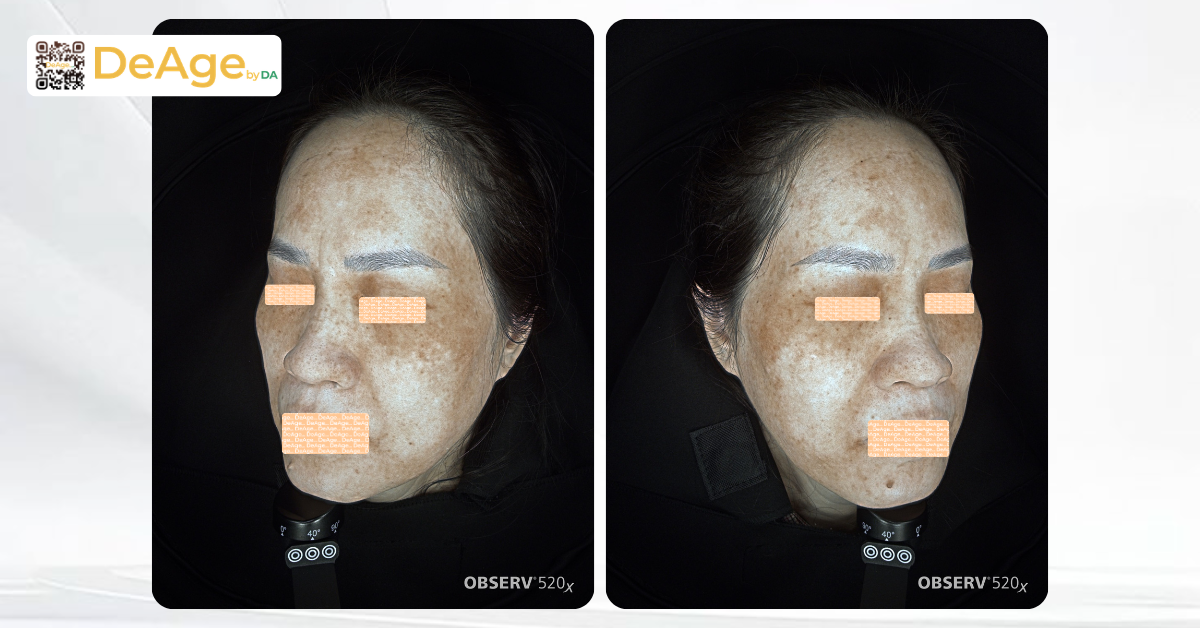 acid tranexamic
