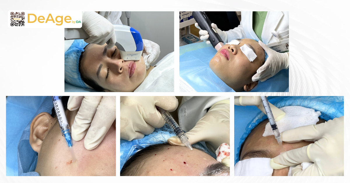 Bí quyết nâng cơ xóa nhăn không phẫu thuật giúp gương mặt trẻ trung hơn 1 công nghệ xóa nhăn