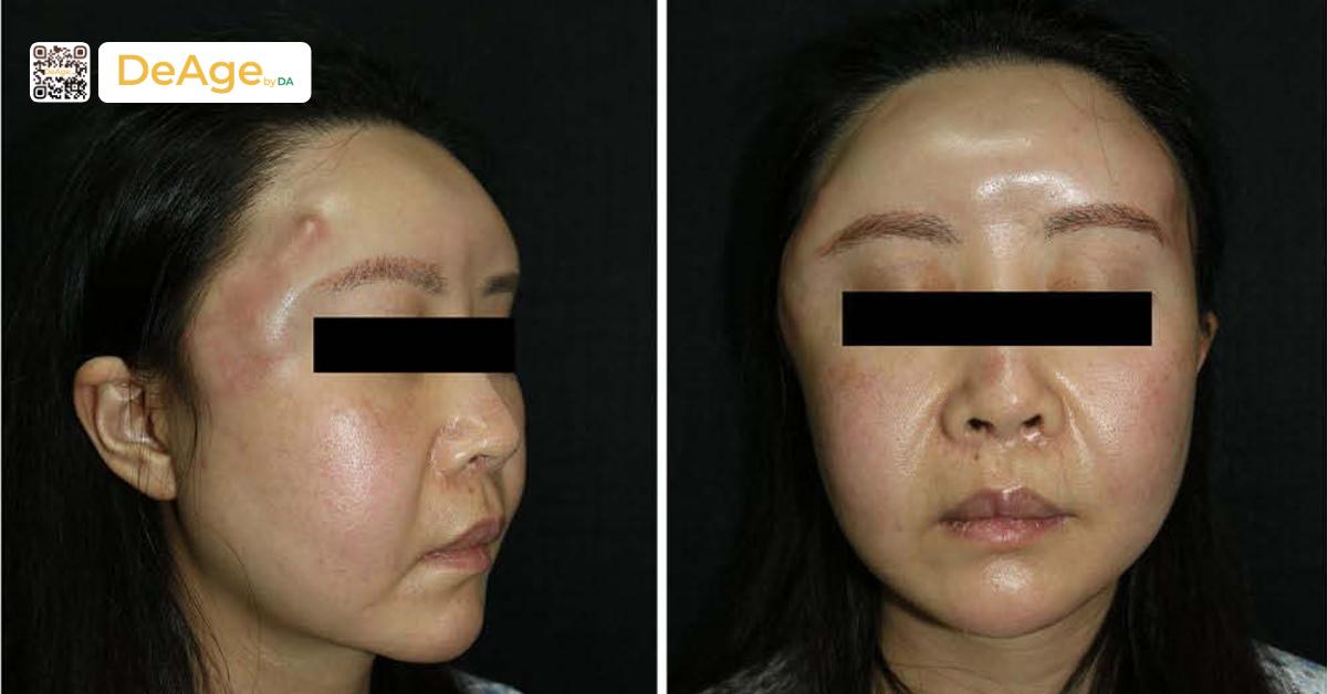 Cấy mỡ thái dương: bí quyết cải thiện gương mặt hóp và thiếu cân đối 9 Cấy mỡ thái dương sai lớp mô có thể làm tăng nguy cơ tụ dịch (hình minh họa)