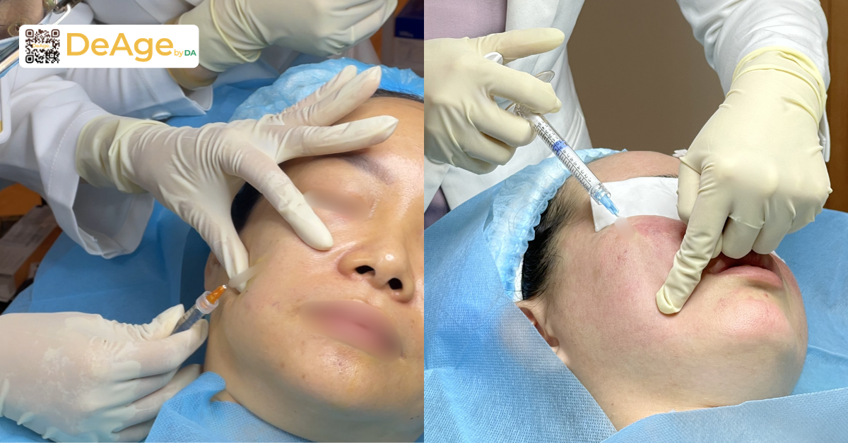 Da bị lão hóa sớm: dấu hiệu nhận biết, nguyên nhân và cách cải thiện 8 Tiêm skinbooster và biostimulator