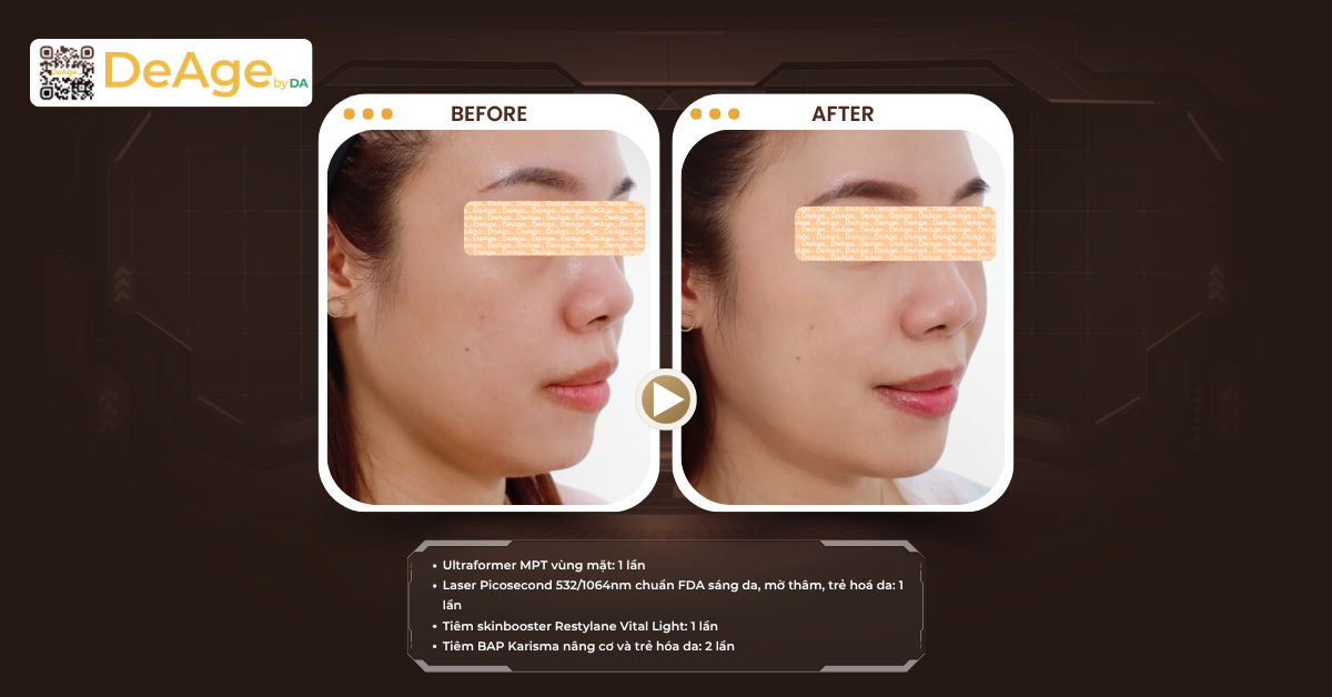 Top 10 cách có cằm V-line đẹp tự nhiên: phương pháp nào phù hợp với bạn? 14 CLS