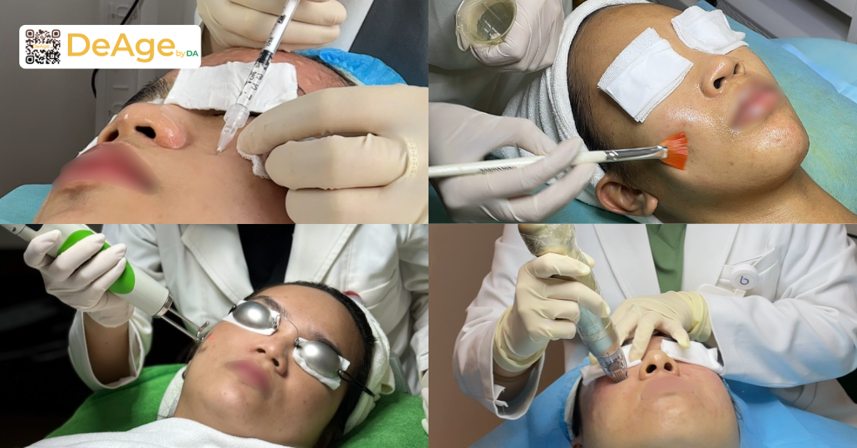 Tìm hiểu cấu trúc da nám: chìa khóa để lựa chọn phương pháp xử lý phù hợp 7 Cách xử lý và phục hồi làn da bị tăng sắc tố sau laser trị nám