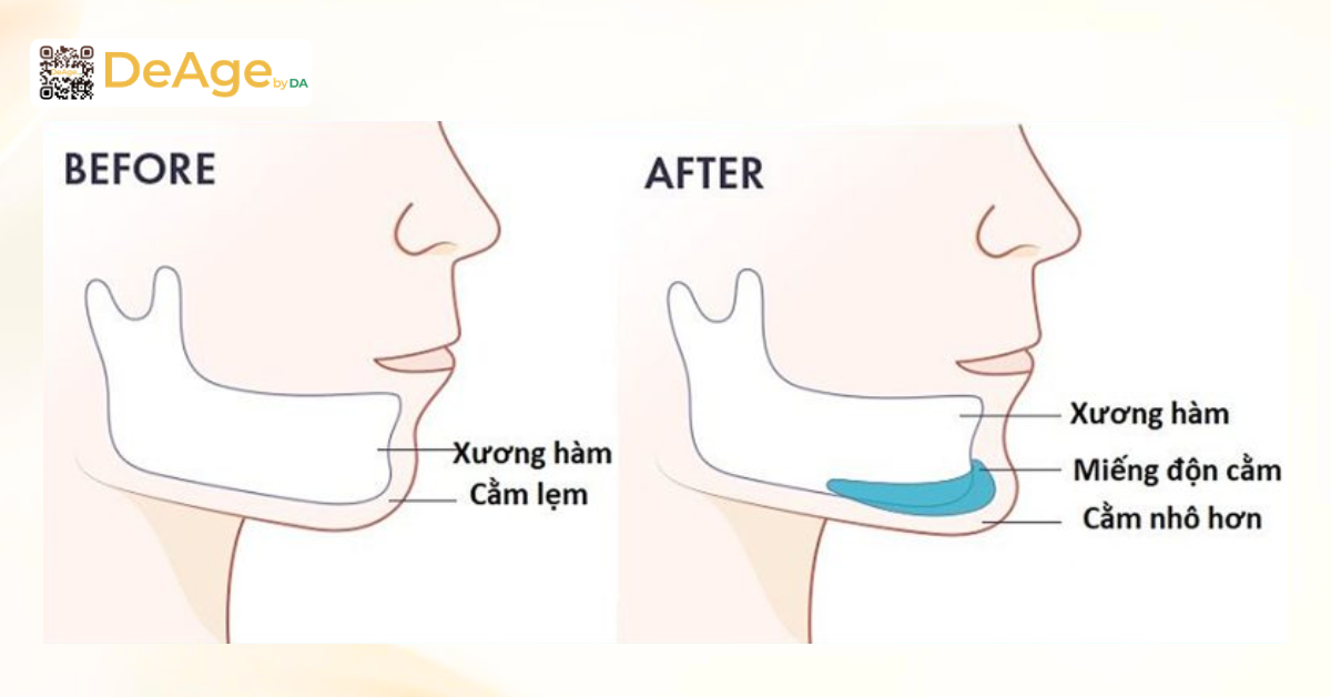 Cách làm cằm thon gọn có khó như bạn nghĩ? Bật mí 8 phương pháp phổ biến hiện nay 9 Độn cằm