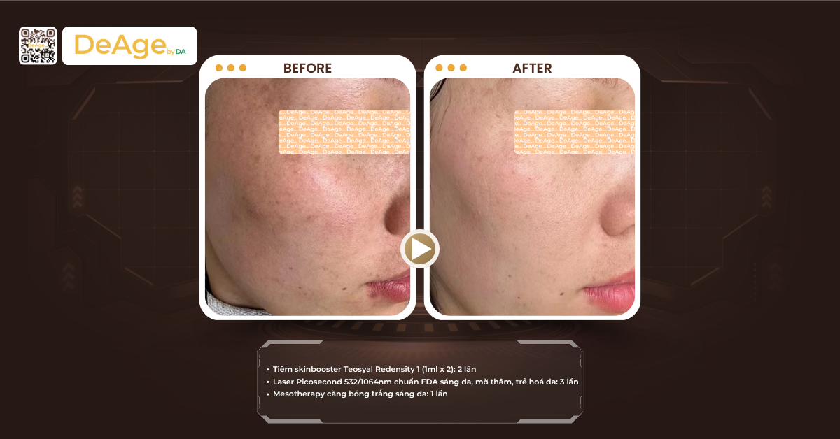 Tìm hiểu cấu trúc da nám: chìa khóa để lựa chọn phương pháp xử lý phù hợp 9 Nuôi dưỡng làn da từ bên trong