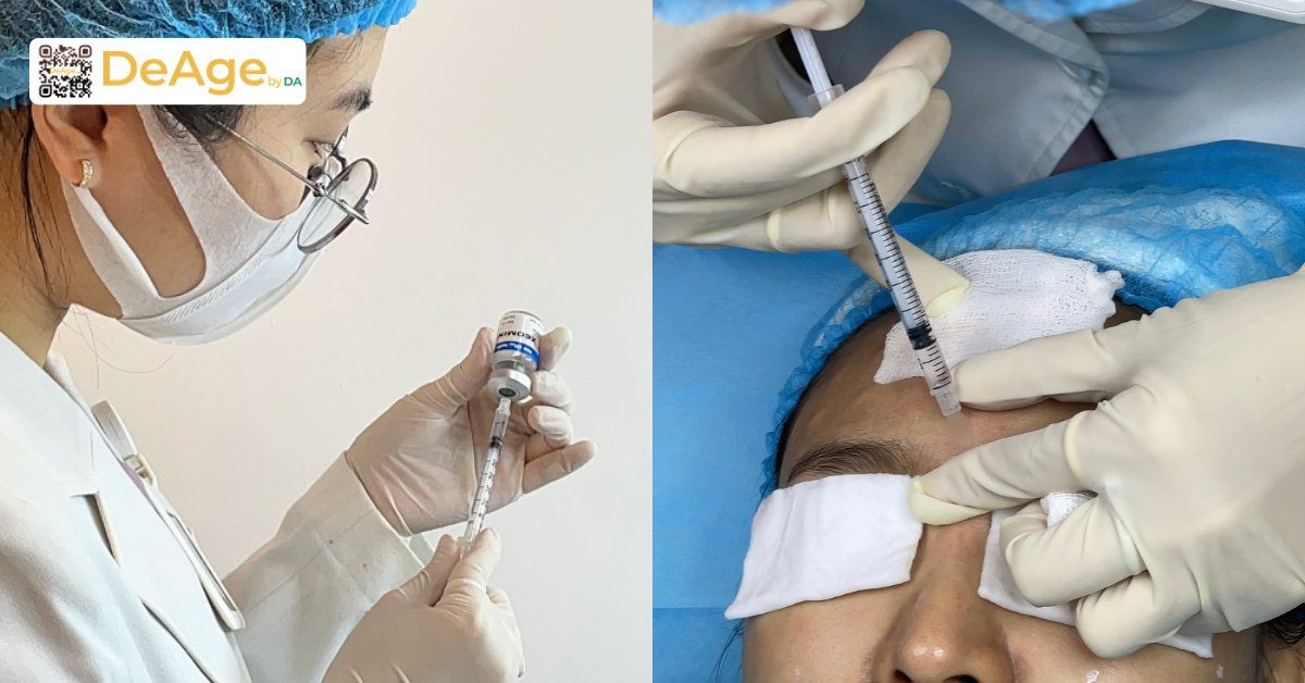 Tiêm botox được thực hiện bởi Bác sĩ DeAge by DA nhằm đảm bảo kỹ thuật tiêm chính xác và an toàn