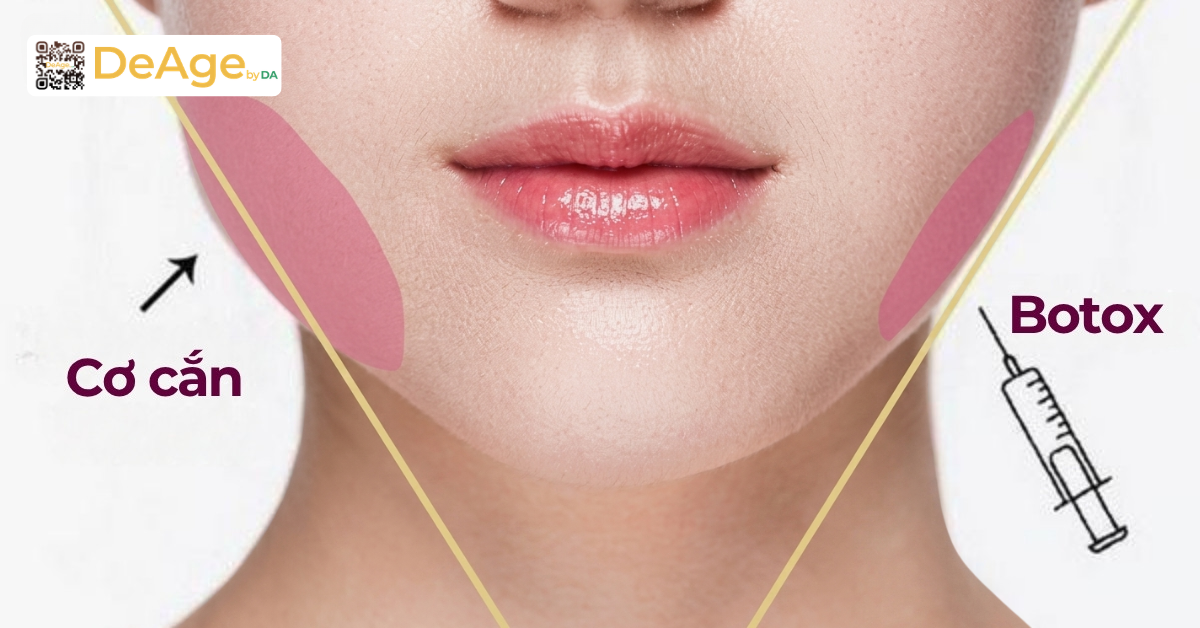 Tiêm botox thon gọn hàm