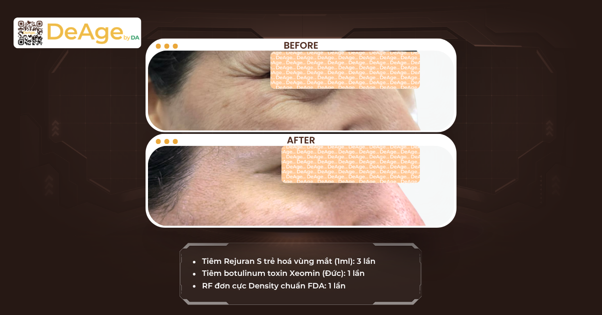 Tiêm botox