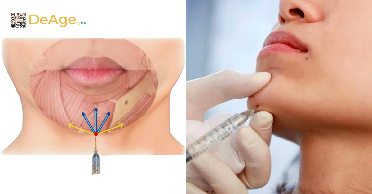 Tiêm filler tạo hình cằm