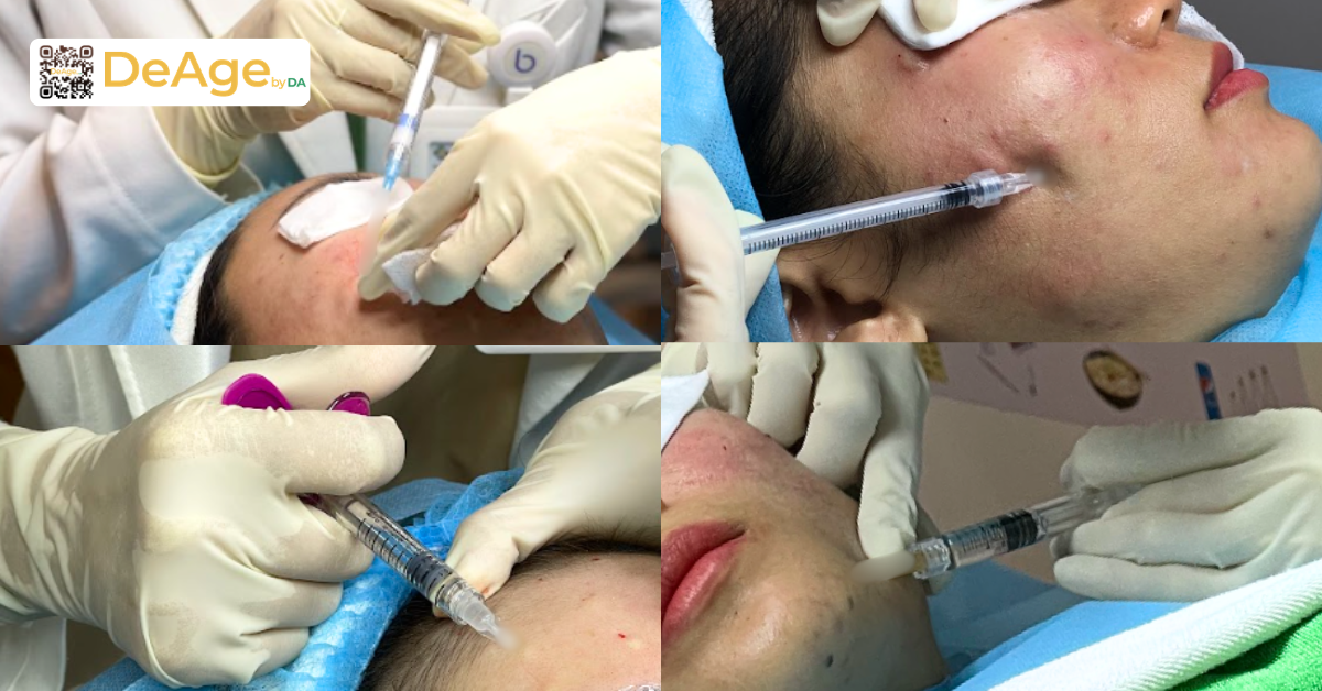Căng da mặt cho nam: giải pháp cải thiện da chùng nhão và nếp nhăn tuổi tác 8 Tiêm trẻ hóa da