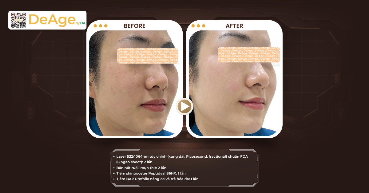 tiêm skinbooster và biostimulator