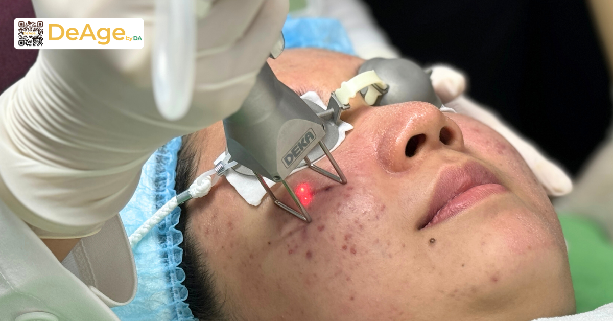 Laser tái tạo