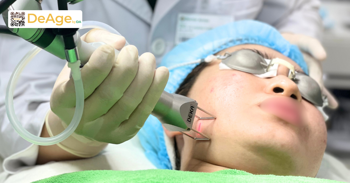 7 cách làm da căng bóng, mịn màng chuẩn xu hướng Hàn Quốc 11 Laser giúp cải thiện bề mặt da mịn màng hơn