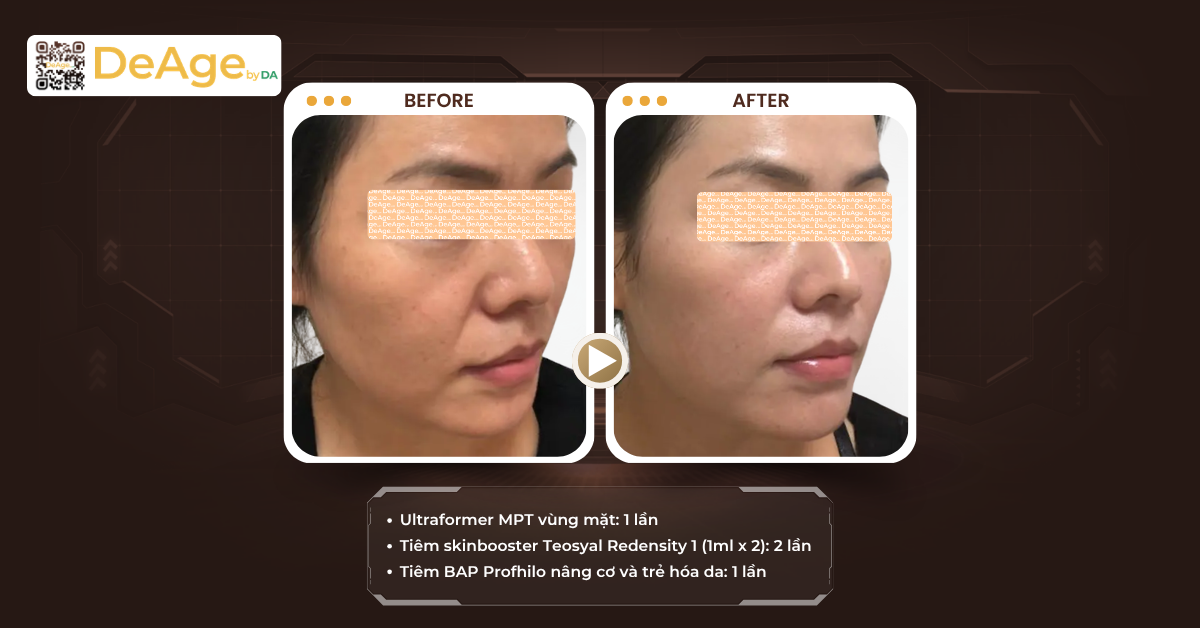 Da bị lão hóa sớm: dấu hiệu nhận biết, nguyên nhân và cách cải thiện 3 Sử dụng công nghệ cao