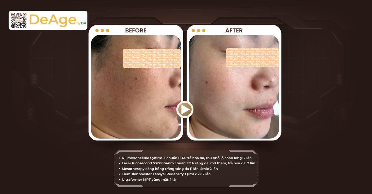 Tăng sinh collagen là gì? Giải pháp giúp da săn chắc và trẻ hóa hiệu quả 9 ca lâm sàng có RF, HIFU
