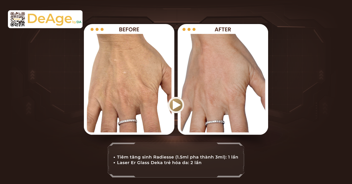 Tiêm biostimulator