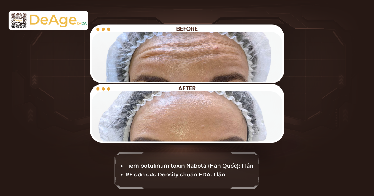 Tiêm botox
