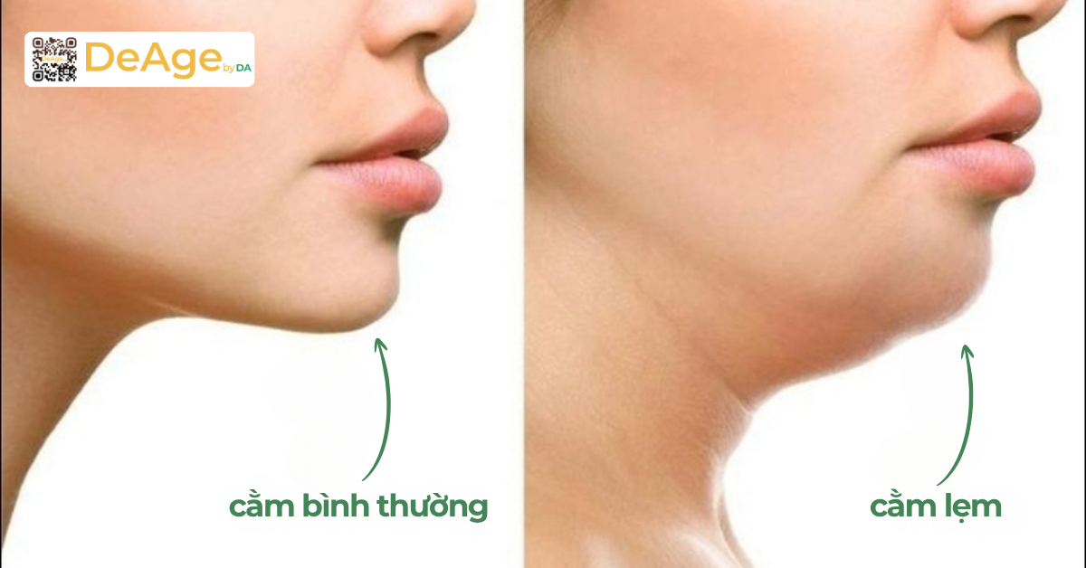 Tiêm cằm tròn tài lộc phù hợp với ai