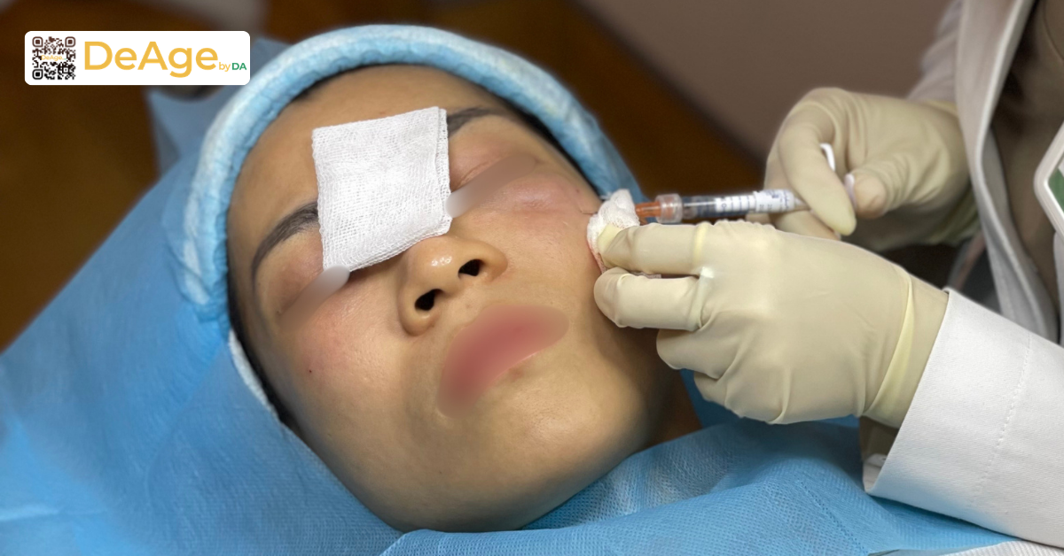 7 cách làm da căng bóng, mịn màng chuẩn xu hướng Hàn Quốc 4 Tiêm skinbooster giúp tăng độ ẩm, cải thiện độ đàn hồi và làm mịn bề mặt da tại DeAge by DA