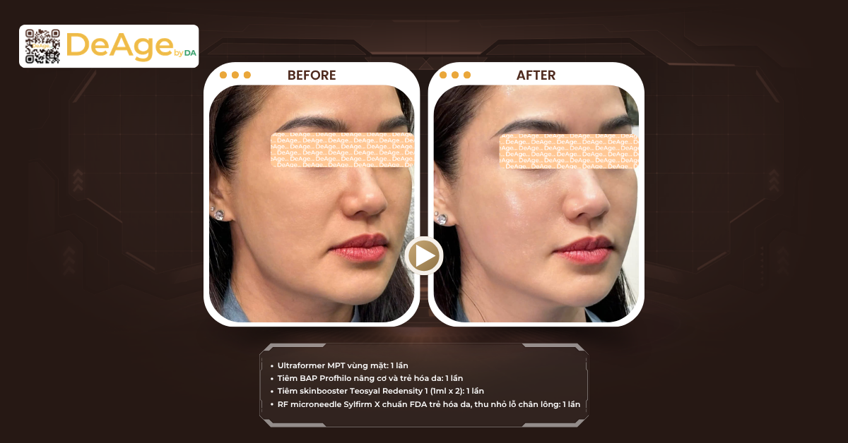 Tiêm skinbooster và biostimulator