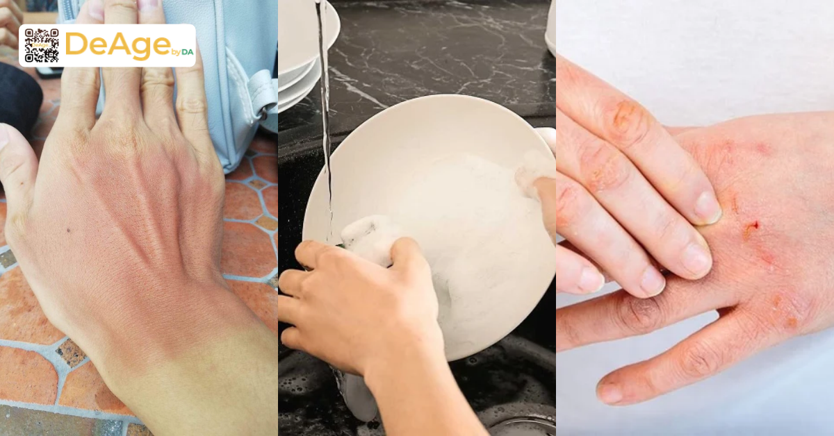 Vì sao da tay dễ khô sần và lão hóa sớm