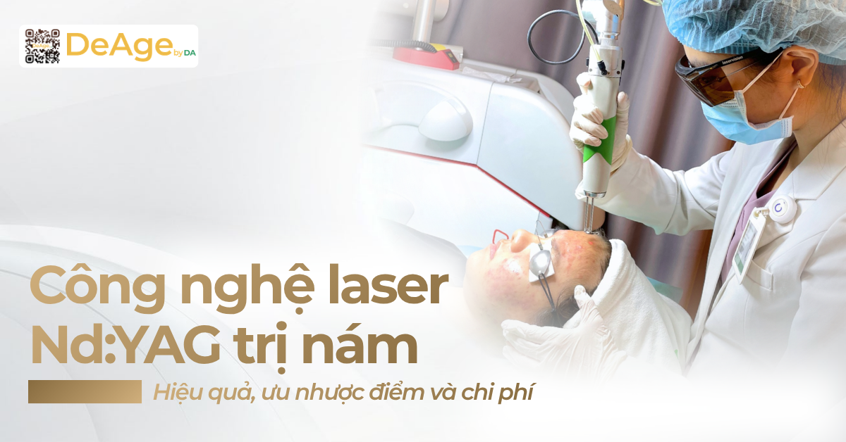 thumb Công nghệ laser NdYAG trị nám hiệu quả, ưu nhược điểm và chi phí