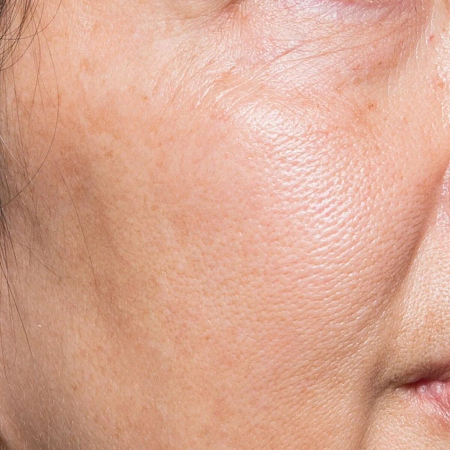 Da chùn nhão có nếp nhăn nhẹ