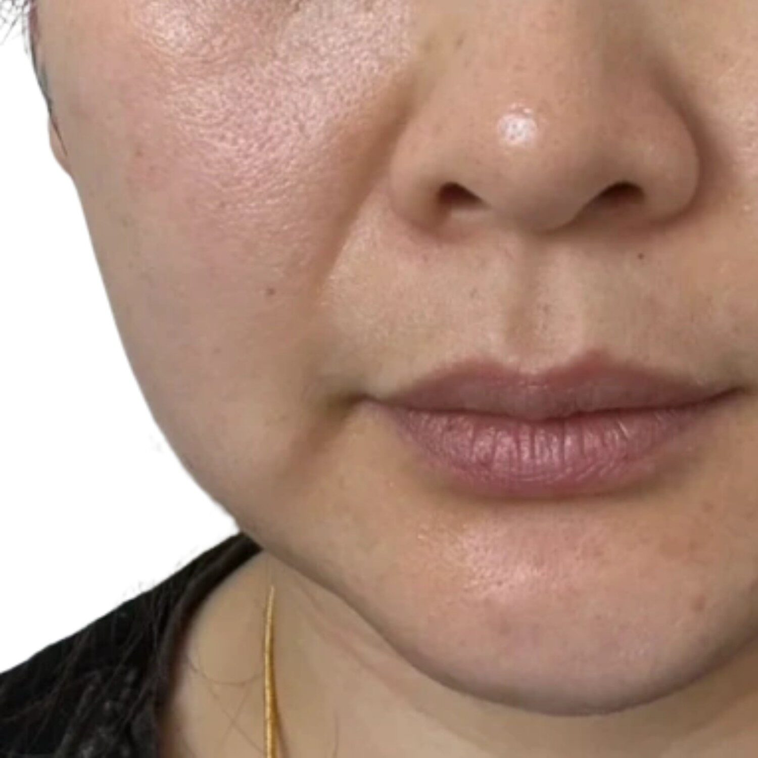 Da mặt nhiều mỡ