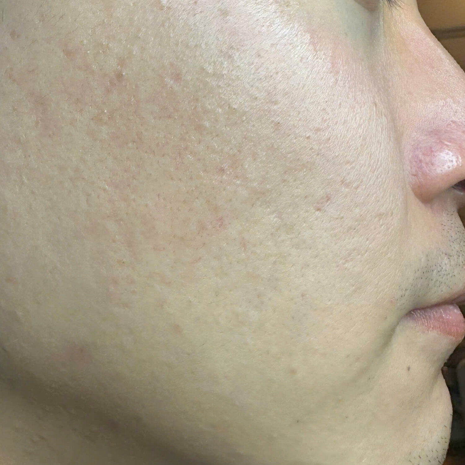 Da thô ráp, mất căng bóng