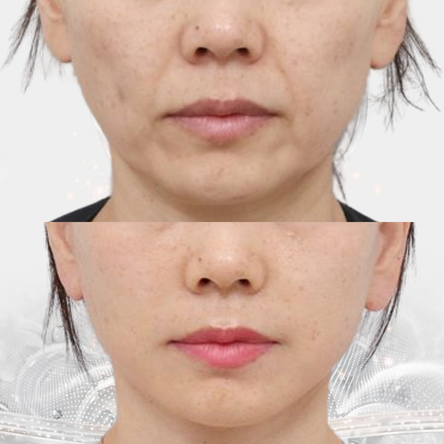 Làm mờ rãnh sâu và nếp nhăn nông