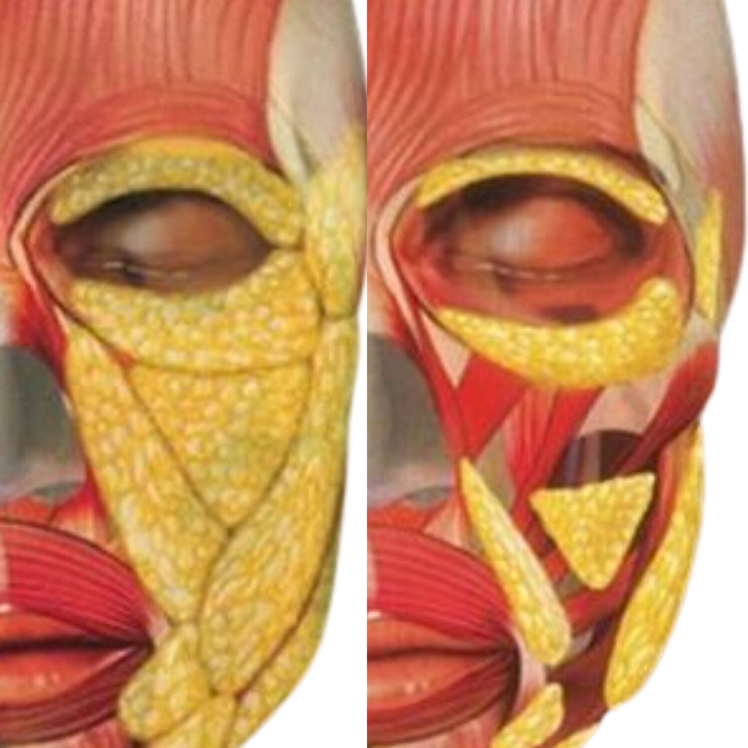 Lớp mỡ dưới da tái phân bố theo thời gian