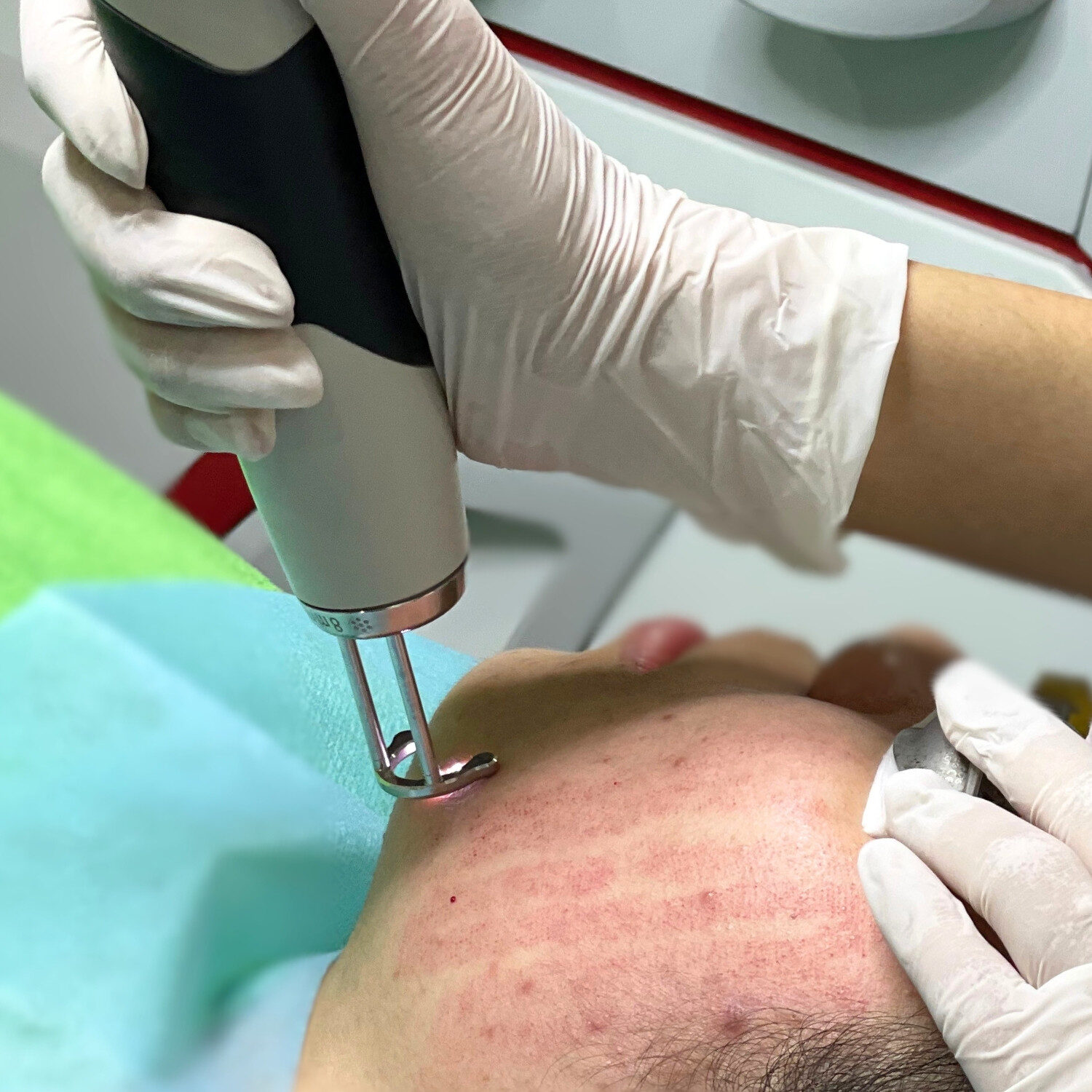 Người cần phục hồi da sau thủ thuật_1