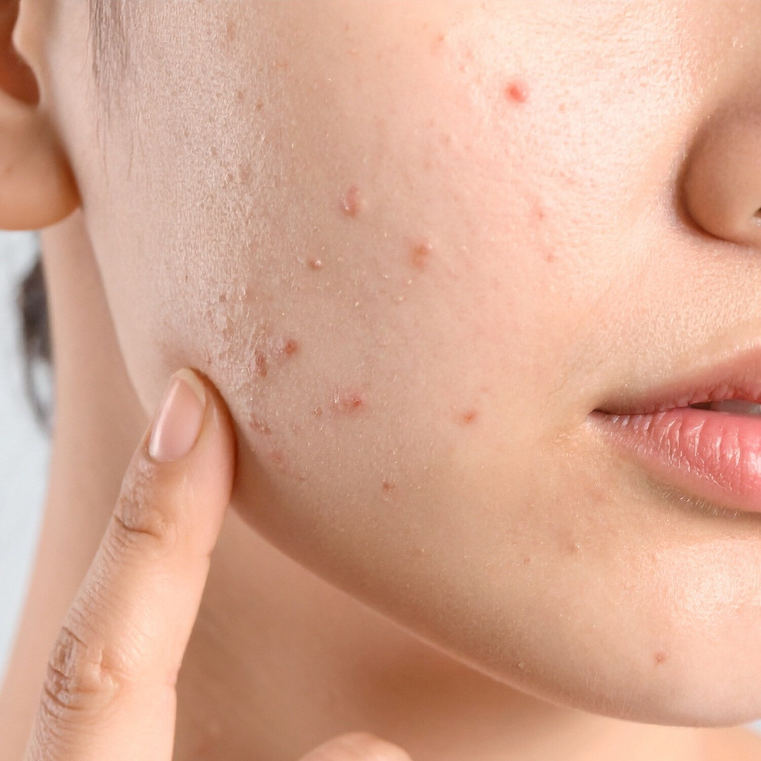 Người có da tổn thương sau mụn
