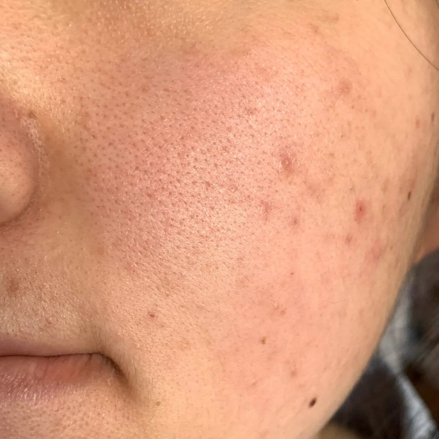 Người sẹo mụn, lỗ chân lông