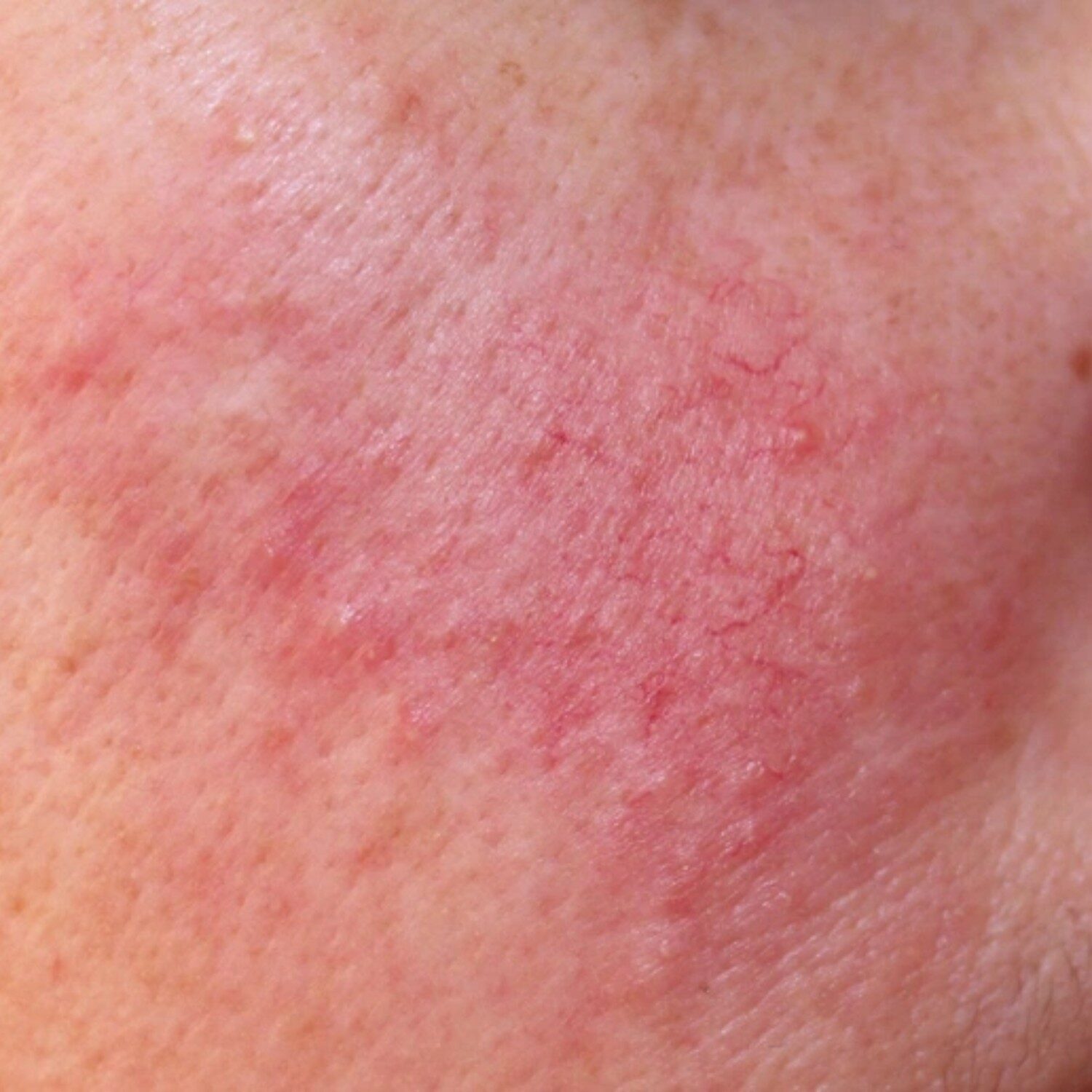 Trứng cá đỏ, giãn mạch